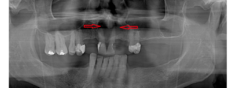 Pantomogram