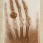 Roentgen ręki